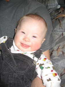 baby with Down syndrome